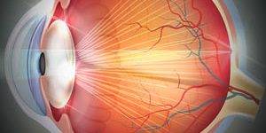 Eye Gallery Catarcts 300x150 300x150